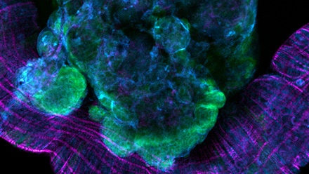 A tumour in a Drosophila model of colorectal cancer 